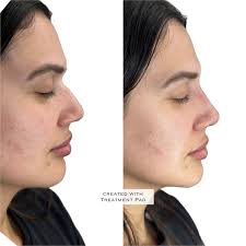 Just like magic 😍 Liquid rhinoplasty is definitely one of my favourite  treatments to perform! The results from a liquid rhinoplasty can be so  satisfying and so quick, often eliminating the need