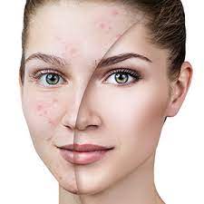 Laser Treatment for Acne Scars Huntington NY - Benefits