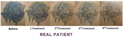 The new tattoo over the laser treated area tattoo by dean holland before after one treatment after two treatments after three treatments before after one treatment before after one treatment/session after 2 treatments/sessions before after one treatment before after one treatment after 2 treatments before after one treatment after 2 treatments Laser Tattoo Removal Hesperia Tattoo Removal Redlands