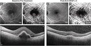 I definitely will be shopping with them again! Incomplete Response To Anti Vegf Therapy In Neovascular Amd Exploring Disease Mechanisms And Therapeutic Opportunities Sciencedirect