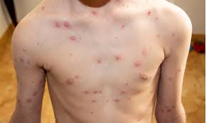 What does chicken pox look like? Sukar Sembuh Inilah Jenis Tahapan Dan Gejala Herpes Yang Perlu Diketahui Cermati Com