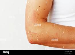 Image result for Photodermatitis
