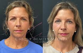 Neurotoxins Near Valrico