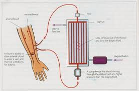 They look at the role of blood cells in our bodies, as well as how the heart, lungs, arteries and veins work together to move blood cells around the body.the questions test reading ability and comprehension, and give students the opportunity to reflect on what they've learned about blood and how. Dialysis Biology Notes For Igcse 2014