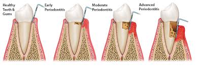 What Is A Perio Chart Maritza O Jenkins Dmd General Dentist