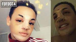 A cantora vai relembrar o passado no programa caldeirão do huck deste sábado, dia 26. Pabllo Vittar Apos Cirurgia Do Nariz Rinoplastia Antes E Depois Youtube