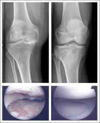 Knie Arthrose Roland Klinik