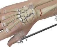Wrist Fracture Fixation Lincoln NE | Wrist Fracture ...