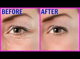 La peau du contour de l'œil est excessivement fragile. Epingle Sur Esthetique