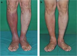 Image result for Lipodermatosclerosis