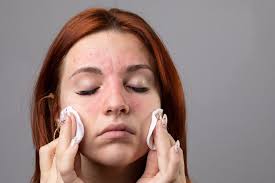 Why skin shame matters more than symptoms in chronic skin conditions