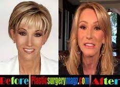 Berrett, karen bradley, paula fass, jack pressman, julia rechter, guenter. 250 Plastic Surgery Ideas Plastic Surgery Surgery Celebrity Plastic Surgery