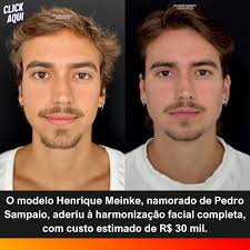 Henrique Meinke, modelo e namorado do cantor Pedro Sampaio, realizou  mudanças visuais com o uso da técnica “full face” de harmonização facial. O  procedimento incluiu aplicação de toxina botulínica, preenchimento no mento  (