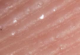 When you go to remove the splinter, don't pinch the skin, dr. How To Remove Ultra Fine Aluminum Swarf Chips Slivers