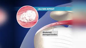 Image result for Rotator Cuff Calcification