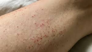 8 Ways To Treat Razor Bumps Fast