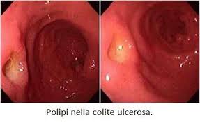 Quando si ha una diagnosi di colite ulcerosa la pancia sembra diventare il principale nemico. Rettocolite Ulcerosa Roma Gastroenterologo Dott Prof Antonio Iannetti