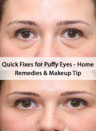 Diygoodtips Com Nbspthis Website Is For Sale Nbspdiygoodtips Resources And Information Puffy Eyes Remedy Puffy Eyes Baggy Eyes