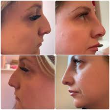 ✨ Side Profile Glow-Up ✨ Ready to elevate your profile with subtle, natural  enhancements? A little nose and lip filler can make a big difference in  balancing and defining your features –