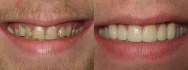 Check spelling or type a new query. Tips For Long Lasting Porcelain Dental Veneers Financial District Dental Care Dr Raymond Hahn Dds