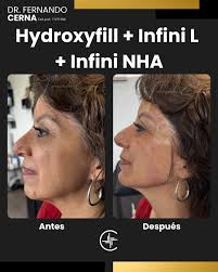 🌟 Soy el Dr. Fernando Cerna y quiero contarte sobre un protocolo que está  transformando pieles: Hydroxifil + Infini L + Infini NHA. ¿Para qué sirve  esta combinación? ✨ Hidrata profundamente desde