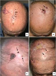 Image result for Leiomyosarcoma