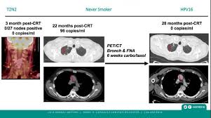 This test measures the different types of cells in your blood. Biomarker Blood Test Accurately Confirms Remission In Hpv Associated Oral Cancer Imaging Technology News