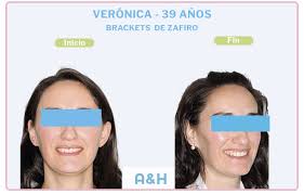Verónica, tratamiento con Brackets de Zafiro