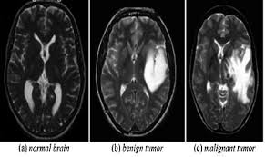 Response in this scheme demands a sustained (ie, &gt; Brain Tumor Classification From Mri Images And Calculation Of Tumor Area Springerlink