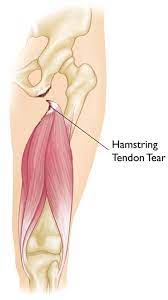 Hamstring Muscle Injuries - Orthoinfo - Aaos