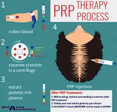 Logbook for prp in industrial settings. Platelet Rich Plasma In Malaysia Prp Malaysia