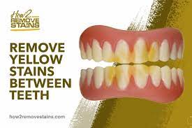 Using an old toothbrush, brush your teeth with this mixture normally. How To Remove Yellow Stains Between Teeth Detailed Answer