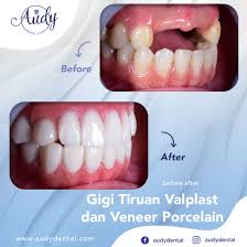 Secara umum berfungsi untuk mengunyah makanan dan untuk estetika. Gigi Tiruan Lepasan Audy Dental
