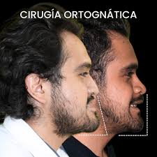 Conoce el excelente resultado de este caso en colaboración  @cmf_manuelsanchez y @doctores.rosales.cmf Con la cirugía ortognática no  solo mejoramos la función sino también la estética y confianza de nuestros  pacientes 😁 #cirugiamaxilofacial #