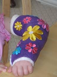 Got A Cast Diy Decorating Ideas Photo 2 Arm Cast Kids Cast It Cast