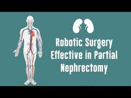 Robotic Partial Nephrectomy Involves Using An Advanced Surgical Robot To Remove Part Of The Kidney Usually The Robotic Surgery Surgical Robots Kidney Surgery