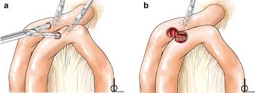 Image result for Enterostomy