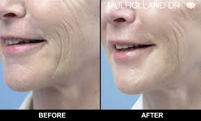 If you opt for a fractional co2 laser resurfacing, mostly a topical anesthetic mask would be chosen, however, for large areas of treatment, your doctor may suggest sedative and pain killers after the procedure as well. Toronto Fractional Co2 Laser Laser Skin Resurfacing Tps