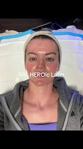 Bbl Heroic Vs Bbl Radiance Laserr