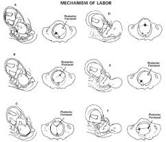 Image result for Manual Rotation in Occipitoposterior Presentation