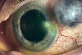 Image result for lesion sclera