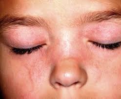 Image result for red rash face