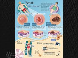 Some of these factors that could be possible causes of skin cancer include: Types Of Skin Cancer Ami 2018 Meeting