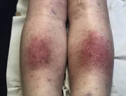 Image result for Lipodermatosclerosis