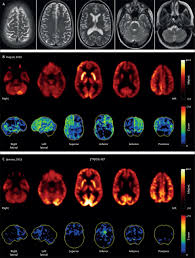 Autoimmune Psychosis An International Consensus On An Approach To The Diagnosis And Management Of Psychosis Of Suspected Autoimmune Origin The Lancet Psychiatry