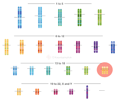 Edwards syndrome is a genetic disorder occurs due to faulty mitotic cell division. A Karyotype Of Edwards Syndrome Explained Karyotypinghub