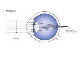 Image result for Refractive Error