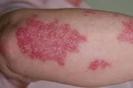 Image result for psoriasis