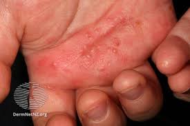 Image result for scabies human bites