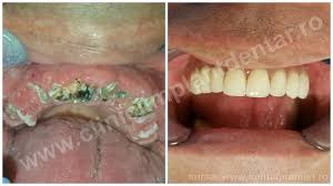 Aceşti 32 de dinți sunt foarte importanţi pentru că fiecare are propria funcție în procesul de mestecare și vorbire. Implant Dentar Pret Avantajele Implanturilor Dentare Fast Fixed